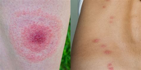 11 Common Bug Bite Pictures - How to ID Insect Bites and Stings