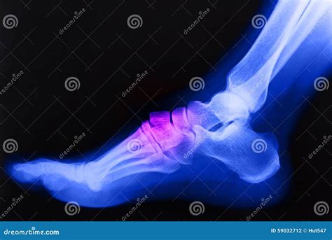 Broken Right Foot Ankle Xray Stock Photography | CartoonDealer.com ...