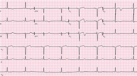 File:Wellens.png - ECGpedia