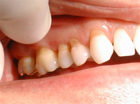 Tooth Abrasion & Tooth Erosion - Lemesos Dental Clinic Ltd