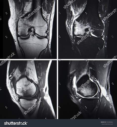 Injured Knee Mri Stock Photo (Edit Now) 351805064 | Shutterstock