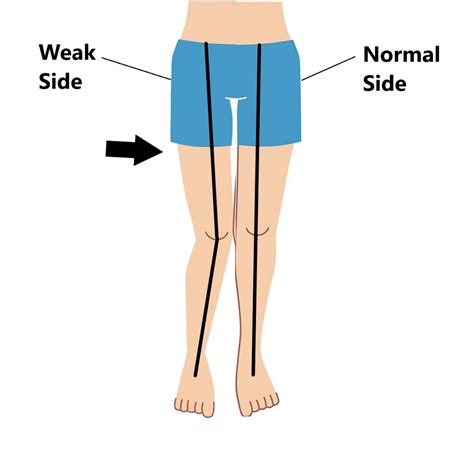 Greater Trochanteric Pain Syndrome (GTPS) - My Family Physio