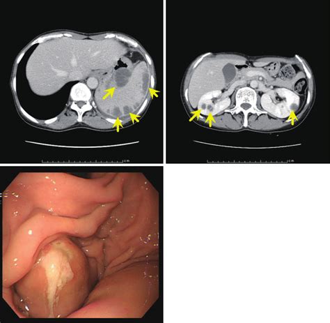 Figure1.Imaging findings of case 1. a, b. Computed tomography of the... | Download Scientific ...