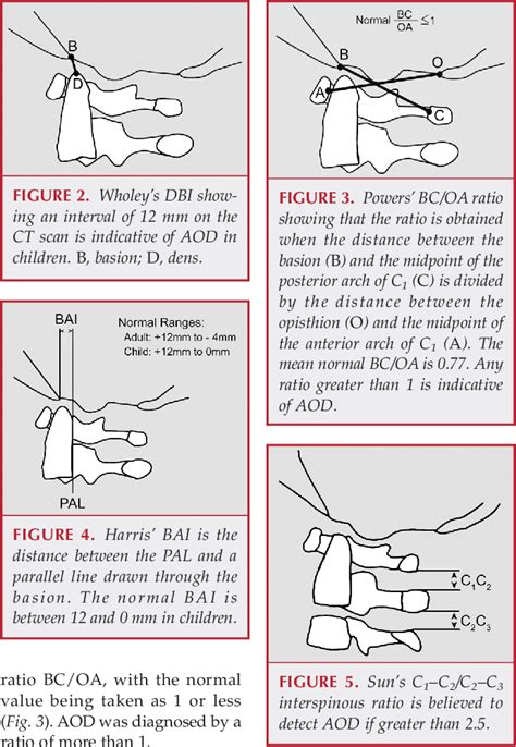 Figure 6 from ATLANTO‐OCCIPITAL DISLOCATION—PART 2: THE CLINICAL USE OF (OCCIPITAL) CONDYLE‐C1 ...