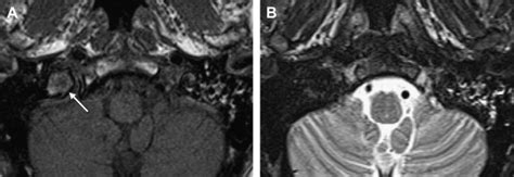 Imaging of Jugular Foramen | Radiology Key