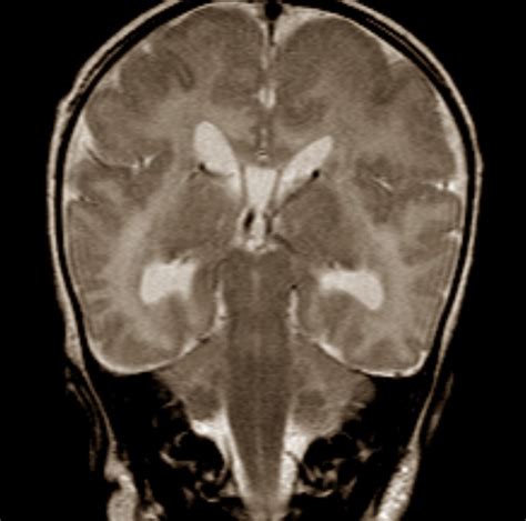 👉 Zellweger syndrome - Pictures, Symptoms, Causes, Treatment (November 2021)