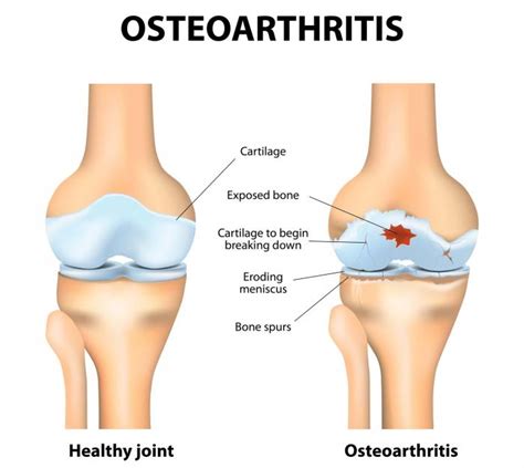 Osteoarthritis: Causes, Symptoms and Treatments - Medical News Today