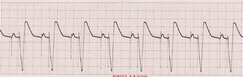 EKGs for Nurse Practitioner & Physician Asst. | Multiple Choice Graded Quiz