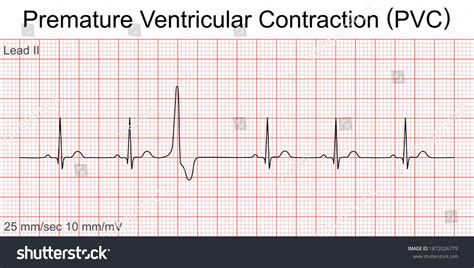 PVC EKG Image