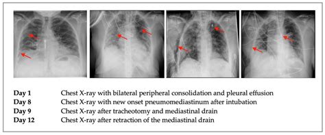 COVID | Free Full-Text | Survival by Mediastinal Chest Drain Due to Pneumomediastinum Resulting ...