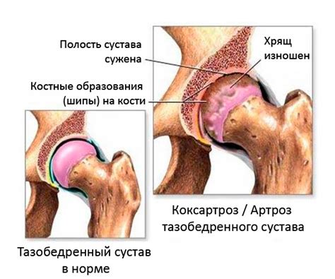 Osteophytes of the hip joint: symptoms, treatment