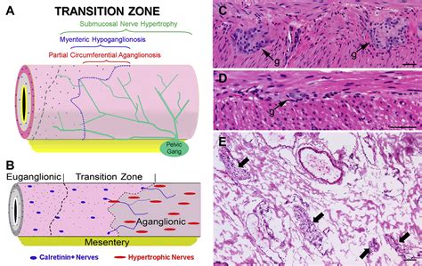 Advances and Pitfalls in the Diagnosis of Hirschsprung Disease - Surgical Pathology Clinics