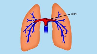 What is Saddle Pulmonary Embolism - Definition, Symptoms, Causes ...