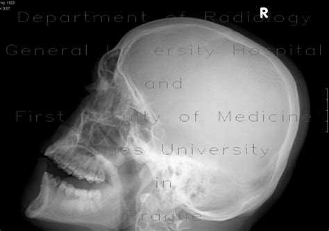 Radiology case: Fracture of the mandible