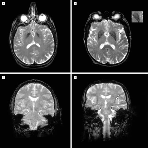 Brain Magnetic Resonance Imaging in Multiple-System Atrophy and Parkinson Disease | Movement ...