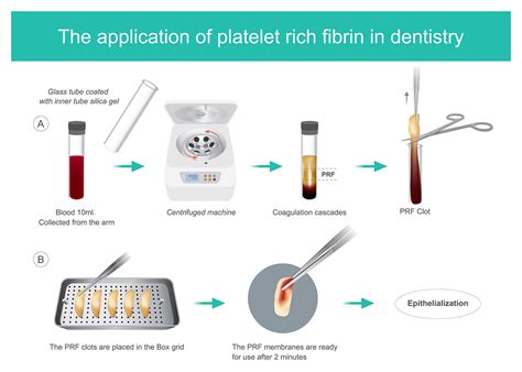 Platelet Rich Fibrin | Ashford Dental