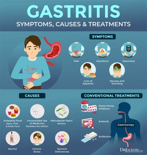 Marvelous Info About How To Prevent Gastritis - Fishingcream