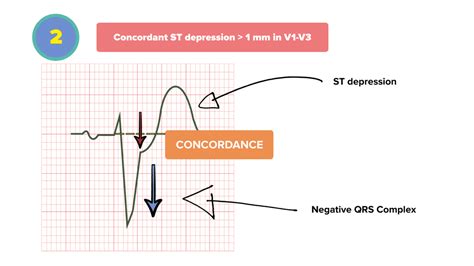 Sgarbossa Criteria | Nucleotype