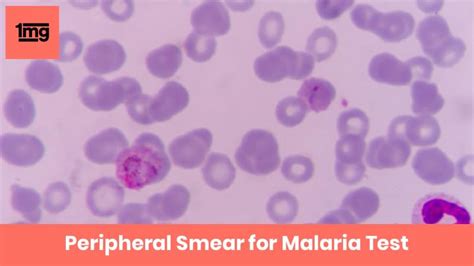 Peripheral Smear for Malaria : Purpose & Normal Range of Results | 1mg