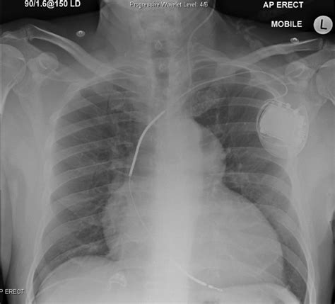 A Chest Radiograph after Cardiac Surgery - INTENSIVE