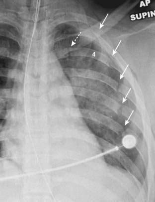 Flail Chest X Ray