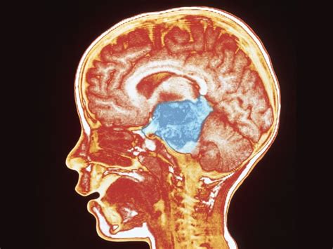 Survival Varies by Sex in Pediatric High-Grade Glioma