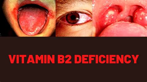 VITAMIN B2 BENEFITS, FOOD SOURCES, DEFICIENCY SYMPTOMS - YouTube