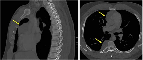 Cureus | Thymoma-Induced Autoimmune Hepatitis: A Rare Paraneoplastic Syndrome