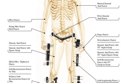 Ultimate Guide of External Fixator - Orthopromed Inc.