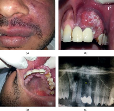 Peripheral Ameloblastoma In Upper Gingiva In 37-Year-Old