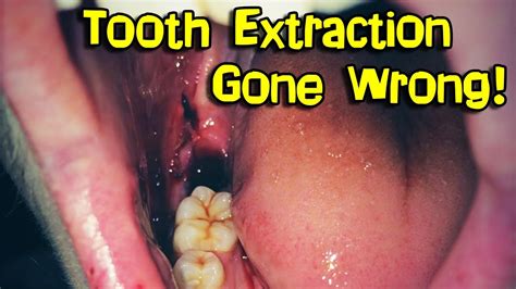 Crazy Tooth Extraction!!! - YouTube