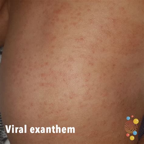 212+ Images Of Viral Rashes - MyWeb