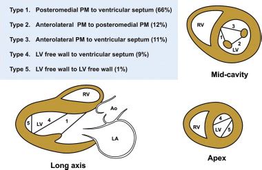 Left Ventricular False Tendons: Anatomic, Echocardiographic, and Pathophysiologic Insights ...