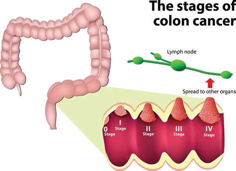 Colon Cancer Stages | Moffitt