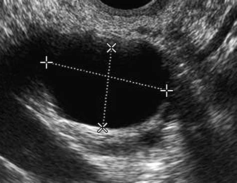 Ultrasound and Assessment of Ovarian Cancer Risk | AJR