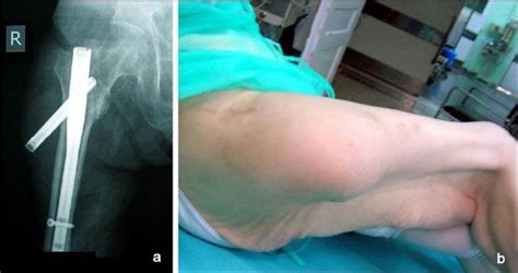 Bruising After Hip Replacement Surgery | Bulge After Hip Replacement