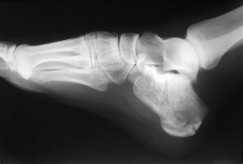 File:Calcaneus Fracture.jpg - Wikipedia