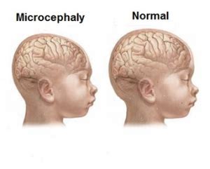 Microcephaly Causes, Symptoms, Diagnosis and Treatment - Natural Health ...