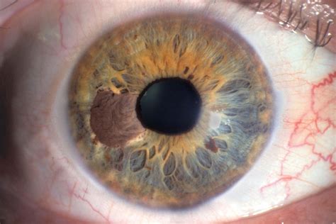TUMORS OF THE UVEA | Optometry Today