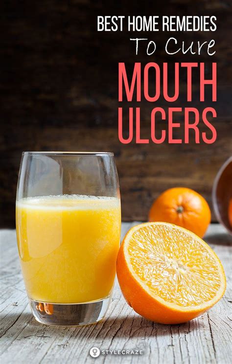 Home Remedies For Mouth Ulcer: 15 Natural Remedies To Try At Home in ...