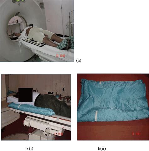 Comparison of geometric uncertainties between alpha cradle and thermoplastic ray cast ...