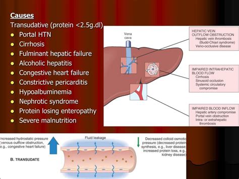 PPT - ASCITES Abnormal accumulation of fluid in the peritoneal cavity Common causes Malignant ...