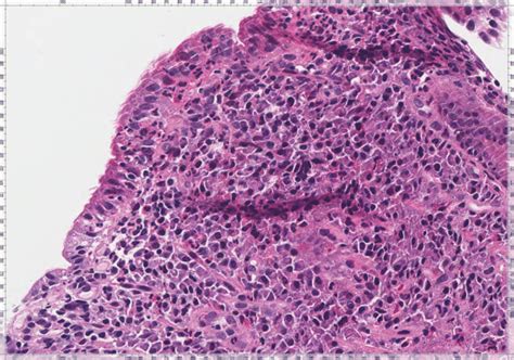 Duodenal mucosa showing villous atrophy associated with increased... | Download Scientific Diagram