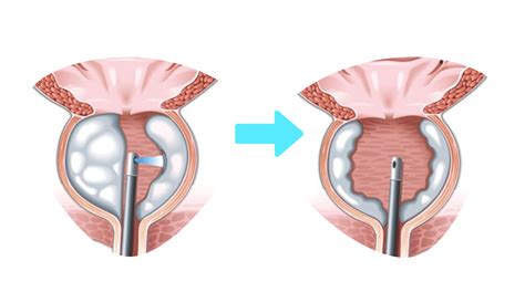 HoLEP BPH Therapy - Eastern Suburb Urology