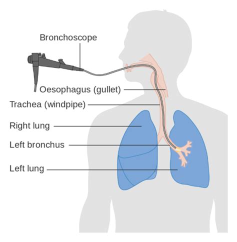 Interstitial Lung Disease | ILD | Respiratory | Geeky Medics