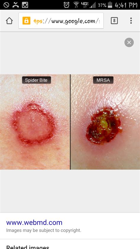 MRSA: Treating it naturally: My journey with MRSA / Cellulitis