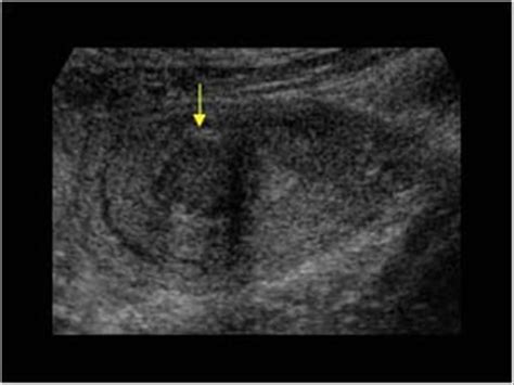 Submucosal fibroid with a hypoechoic mass transverse | Fibroids ...