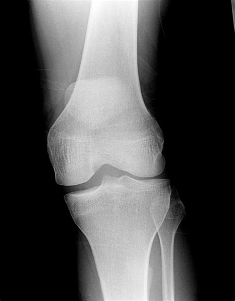 Broken Knee X Ray