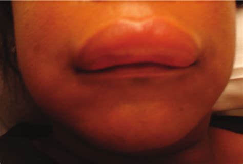 Angioedema Lips