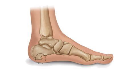 Heel Spur Symptoms & Treatments | Heel That Pain